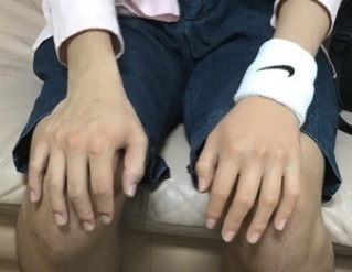 義肢の事例5